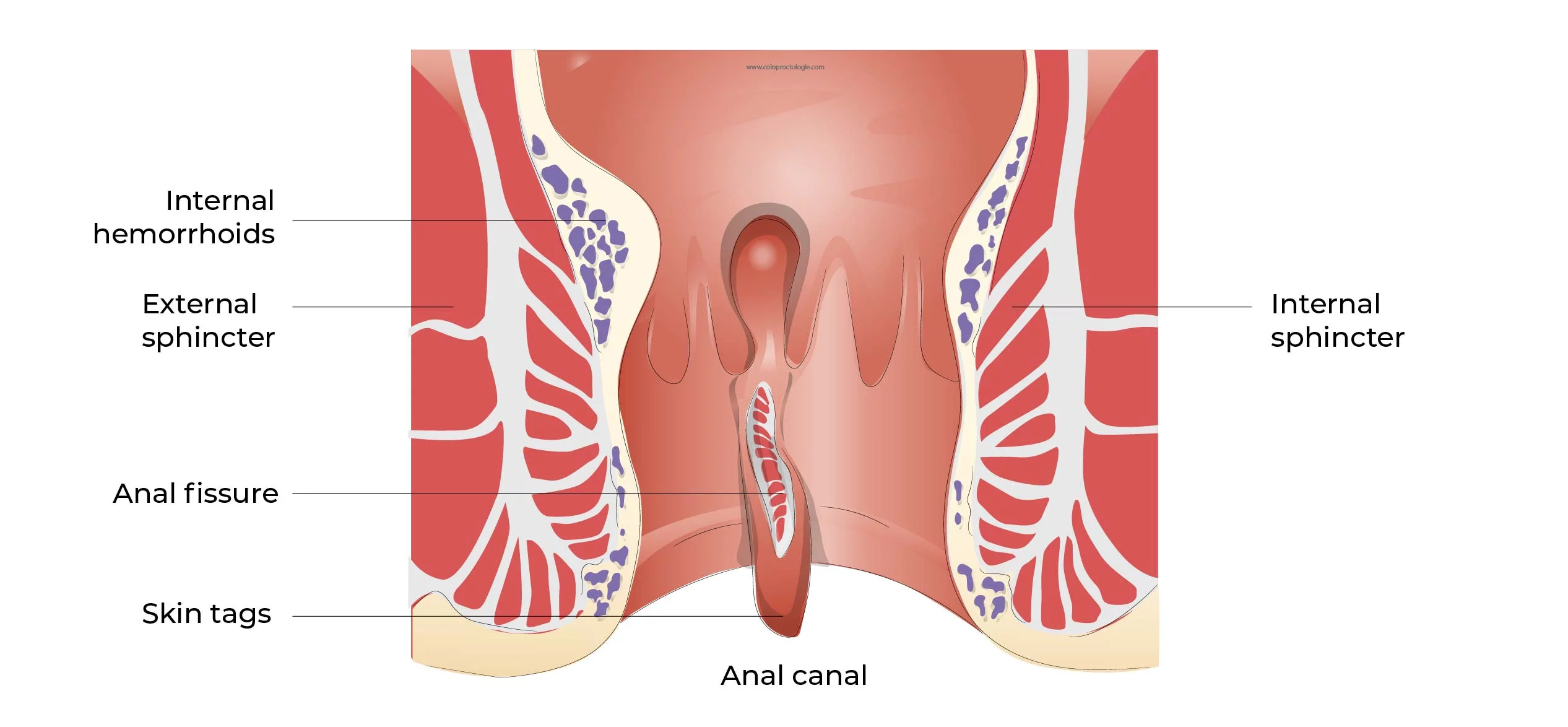 Anal Fissure Treatment at Siyaram Hospital